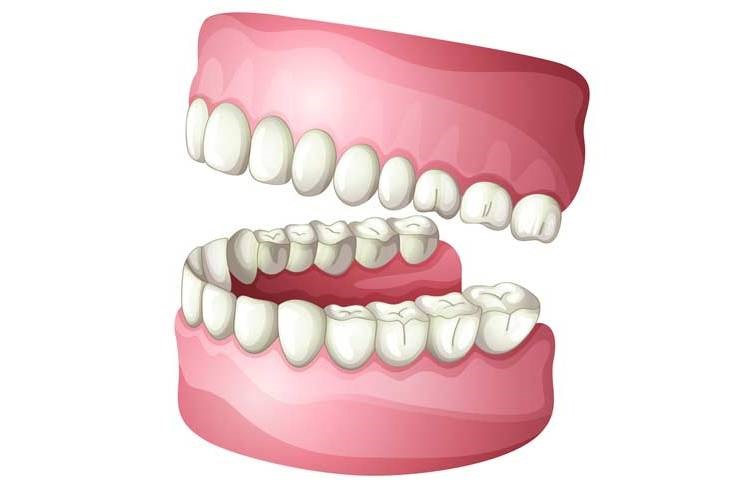 Zest Locators For Dentures Section AL 35771